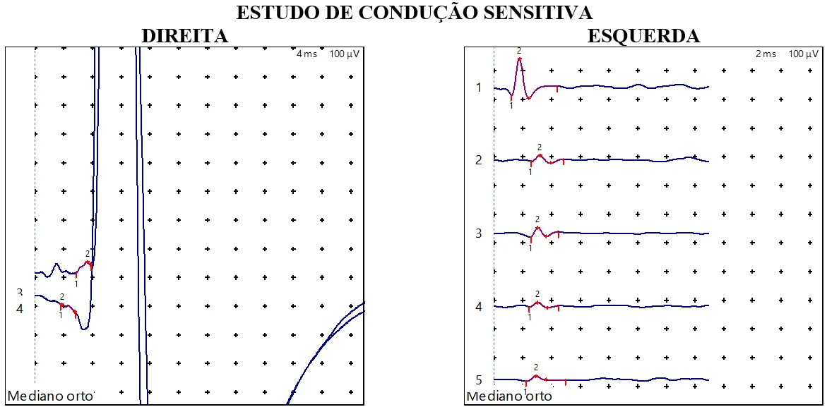 Comparação entre captação inadequada (à direita) e adequada (à esquerda) do nervo mediano sensitivo na eletroneuromiografia. À direita: traçados com forte contaminação do potencial motor e sem linha de base definida. À esquerda: cinco traçados com linha de base estável e potenciais sensitivos limpos.